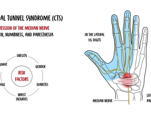 Understanding Carpal Tunnel Syndrome: Causes, Symptoms, and Treatments