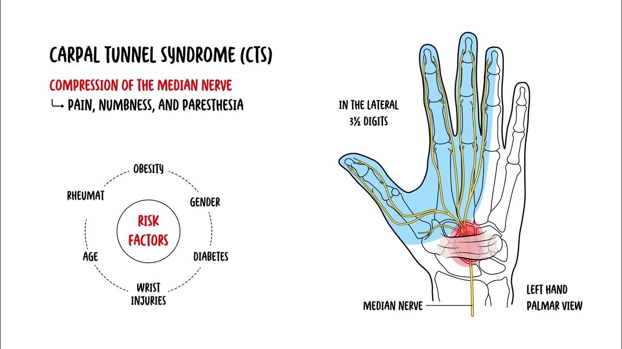 Carpal Tunnel Syndrome